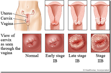 womb cancer and anemia